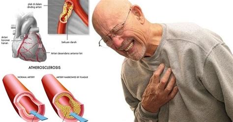 Gambar Tips menjaga kesehatan tubuh secara alami Penyakit Jantung Arteri Koroner